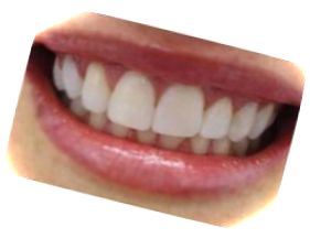 Ровные зубы после процедуры наращивания