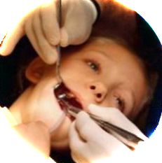 Процедура серебрения зубов