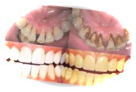 Чистка зубов от отложений