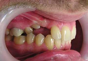 Лечение ретенированных зубов в клинике 